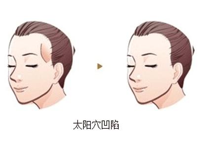 如何提高豐顳術的自體脂肪成活率