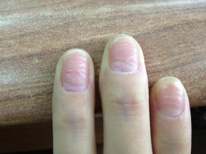 如何預防手指甲凹凸不平?手指甲凹凸不平的危害