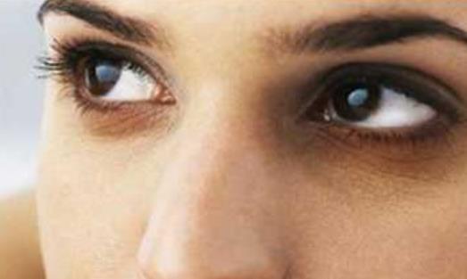 黑眼圈怎么形成的?黑眼圈也分有類型嗎?