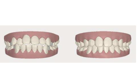 兒童牙齒矯正的最佳年齡 兒童牙齒矯正的方法有哪些