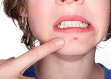 為什么下巴反復(fù)長痘痘？下巴反復(fù)長痘痘是什么原因