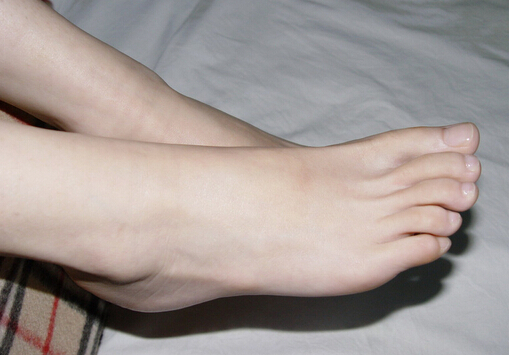 腳上長雞眼怎么辦？如何預防腳上長雞眼