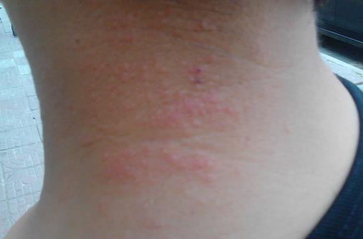 季節性皮炎的預防和治療