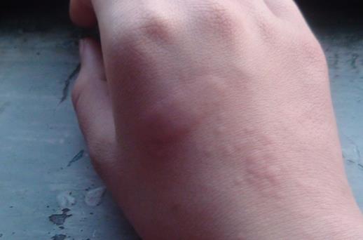 風疹的傳播途徑是什么？ 如何更好的進行防治