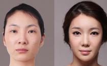 顴骨整形手術有什么優(yōu)勢呢