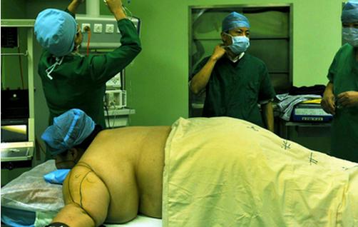 抽脂的5個(gè)秘密不可不知道