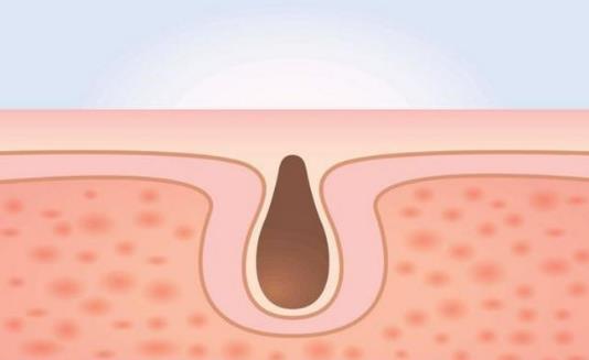 毛孔粗大吃什么好 收縮毛孔最佳飲食營(yíng)養(yǎng)方案