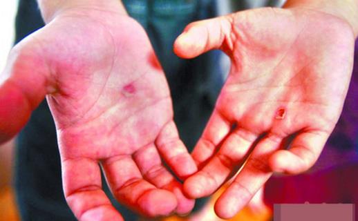 手上長水泡馬上去醫院 預防汗皰疹時的八大注意細