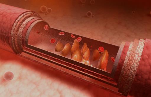 血管變硬竟然是猝死的信號(hào) 3步做好動(dòng)脈硬化的防治