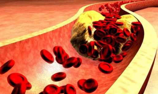 血管變硬竟然是猝死的信號(hào) 3步做好動(dòng)脈硬化的防治