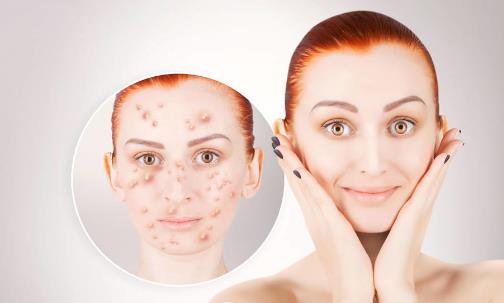 臉上反復(fù)長(zhǎng)痘痘的6大原因
