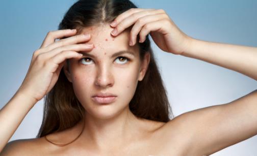 臉上反復(fù)長(zhǎng)痘痘的6大原因