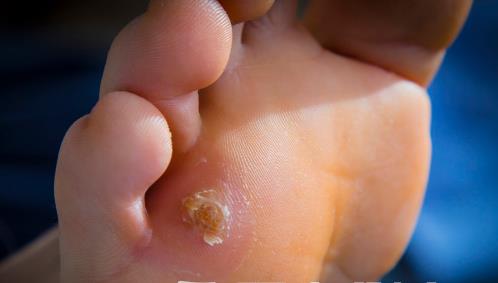 腳下出現(xiàn)老繭比較嚴重怎