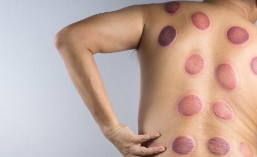 拔火罐能減肥？顏色深代表毒素多、濕氣重？