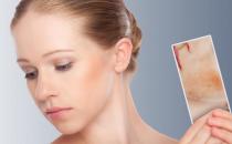 皮炎輕松解決方法 皮炎人群的日常護理法則