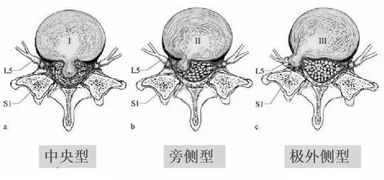 患上腰椎病，一定不能拖！內鏡微創手術，一步治好它！