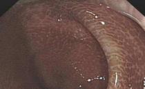 武漢漢西博仕肛腸醫(yī)院：長(zhǎng)期喝清腸茶 警惕結(jié)腸黑變病