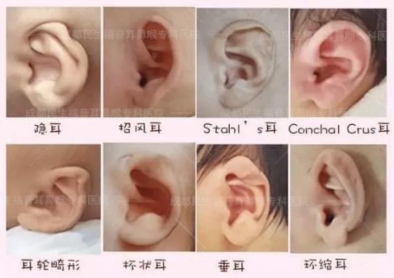新生兒耳廓畸形能矯正嗎？看成都民生耳鼻喉醫院如何支招