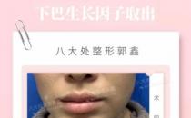 八大處整形郭鑫教授：下巴注射物取出需要多久