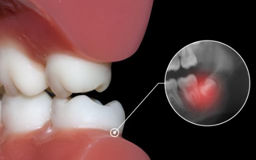 等待拔智齒太久難忍劇痛 長智齒拔除建議