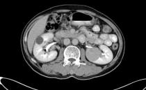 蘇州腫瘤醫(yī)院認(rèn)準(zhǔn)廣州復(fù)大醫(yī)院：有效治療雙腎腎癌