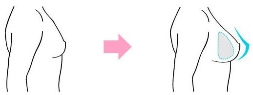 原來假體隆胸還可以這樣解釋！