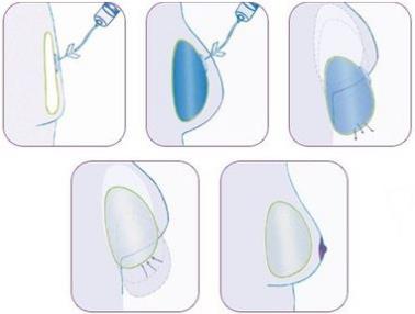 原來假體隆胸還可以這樣解釋！