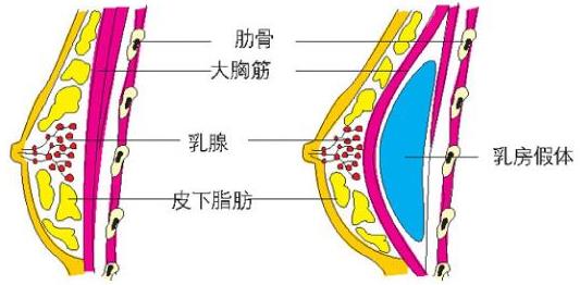 原來假體隆胸還可以這樣解釋！