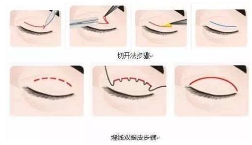 上海玫瑰整形醫(yī)院雙眼皮手術(shù)怎么樣?輕松擁有靚麗雙眼