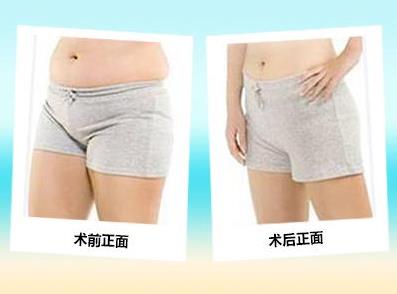 脂肪堆積怎么辦 昆明韓辰360幸福吸脂 無(wú)需住院 苗條立現(xiàn)