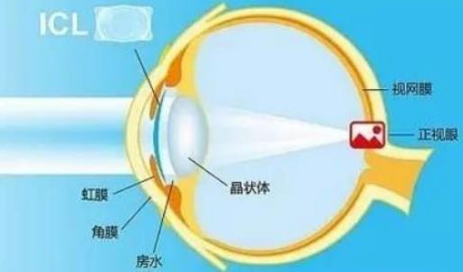 西安普瑞眼科醫(yī)院好嗎？戴眼鏡VS近視手術(shù)，四個(gè)對比讓你不糾結(jié)