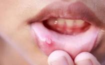 嘴角起小水泡怎么回事，嘴角起了一堆小水泡怎么辦