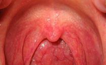 ?喉嚨感覺有東西堵著是怎么回事(喉嚨感覺有東西堵著是怎么回事吃什么藥)